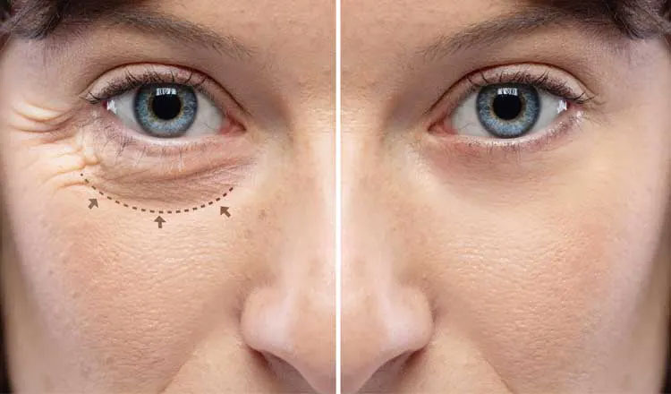 antes e depois blefaroplastia