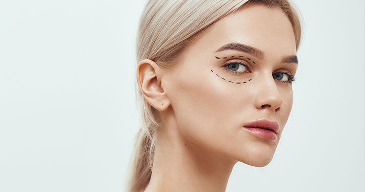 Blefaroplastia a laser