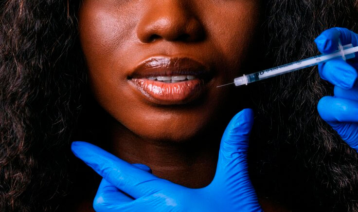 Preenchimento com Ácido Hialurônico