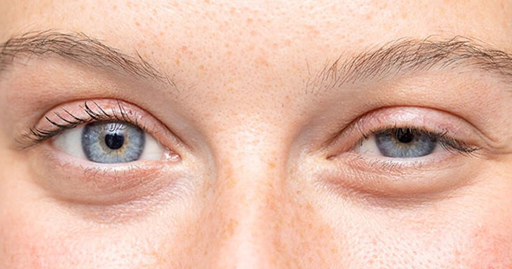 Ptose Palpebral